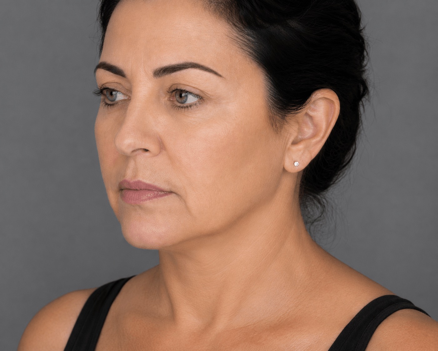 אחרי טיפול Forma – עור מתוח, זוהר ורענן יותר