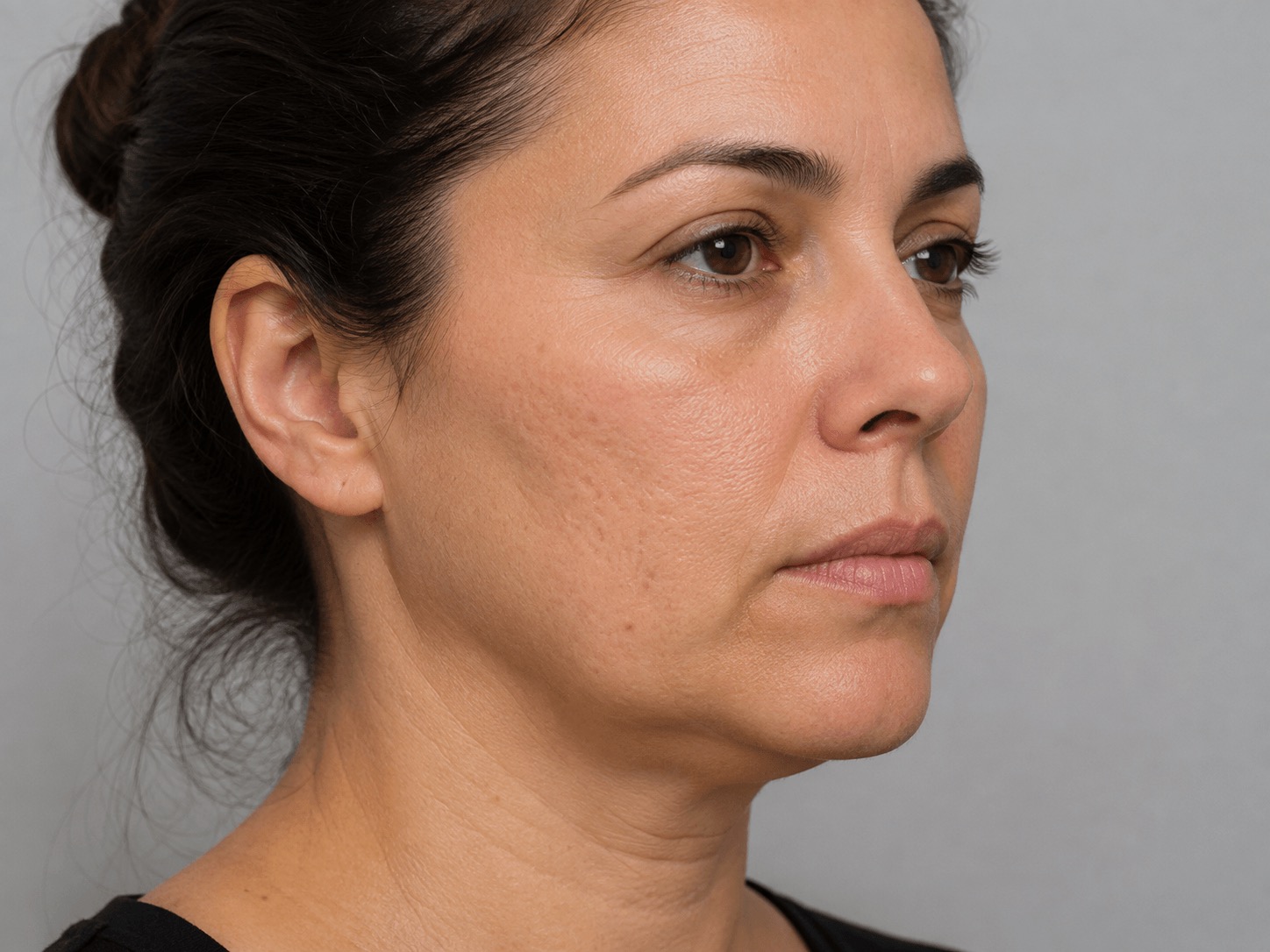 לפני טיפול Fractora – מרקם עור לא אחיד וצלקות אקנה