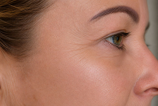 אחרי טיפול פלזמה Fibroblast – עור מתוח והרמה נראית לעין